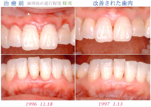 歯周治療