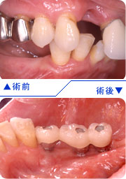 インプラントの埋入前後の口腔内写真