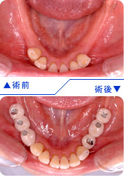 インプラントの埋入前後の口腔内写真