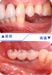 インプラントの埋入前後の口腔内写真