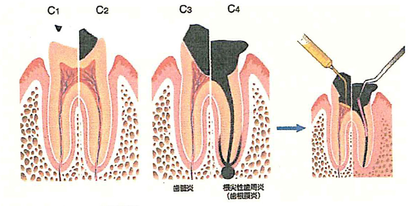 う蝕の症状について(変色、疼痛、口臭、腫脹など)