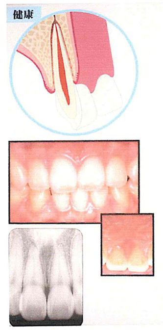 歯周指導