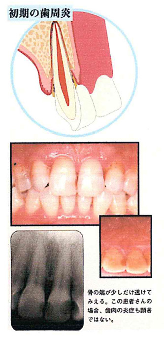 歯周指導