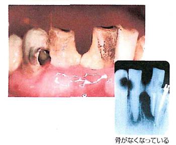 歯周病が進行した歯肉