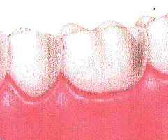 歯周病の予防に必要なこと