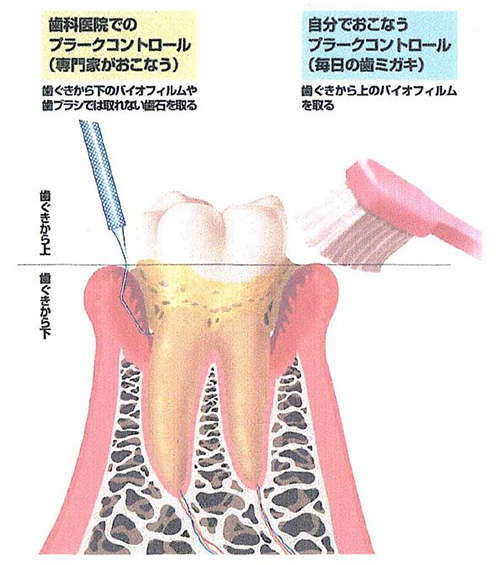 歯周病の予防に必要なこと