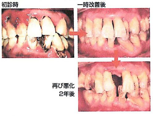 ●定期健診を受けていないで悪化した状態